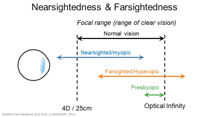 Range of focus for various eye refractive conditions. Myopia shifts the focal range closer, causing bad far sight. Source: Nitish Padmanaban/Stanford
