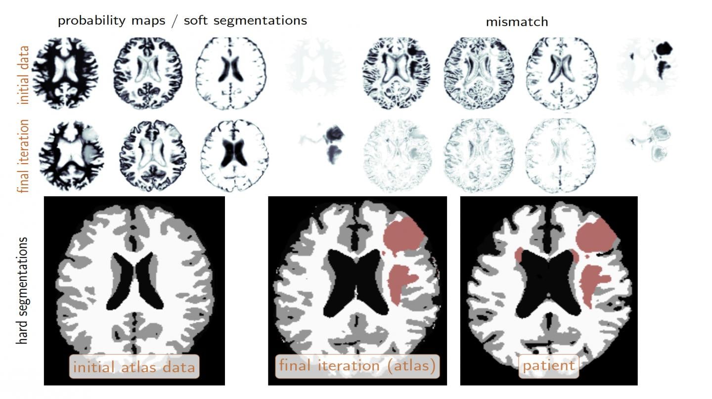 The top row shows the initial configuration. The second row shows the same configuration at the final iteration of the coupled tumor inversion and registration scheme. The three images on the bottom show the corresponding hard segmentation. The obtained atlas based segmentation (middle image) and the ground truth segmentation for the patient are very similar. Source: George Biros
