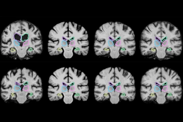 MIT researchers describe a machine-learning algorithm that can register brain scans and other 3D images more than 1,000 times more quickly using novel learning techniques. Source: MIT Media Lab