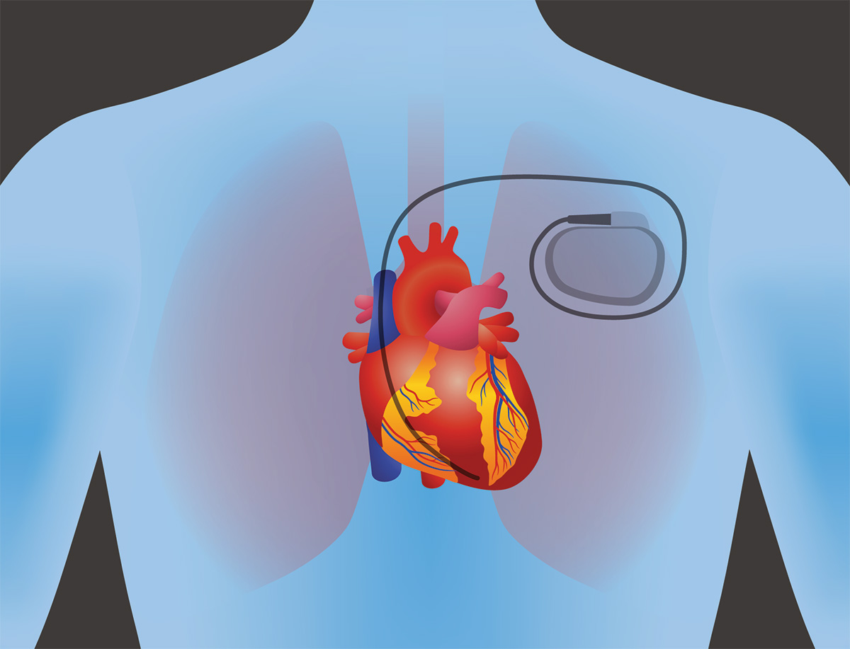 Figure 1. Implanted medical devices, such as this pacemaker, undergo intense scrutiny to ensure safety and biocompatibility. 