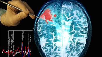Schematic depiction of the probe being used to interrogate brain tissue during surgery. The image shows a photograph of the probe held by a surgeon, Raman spectral associated with normal brain and cancer, as well as a magnetic resonance image of a brain cancer patient with the red area representing the tumor. (Source: Polytechnique Montréal)