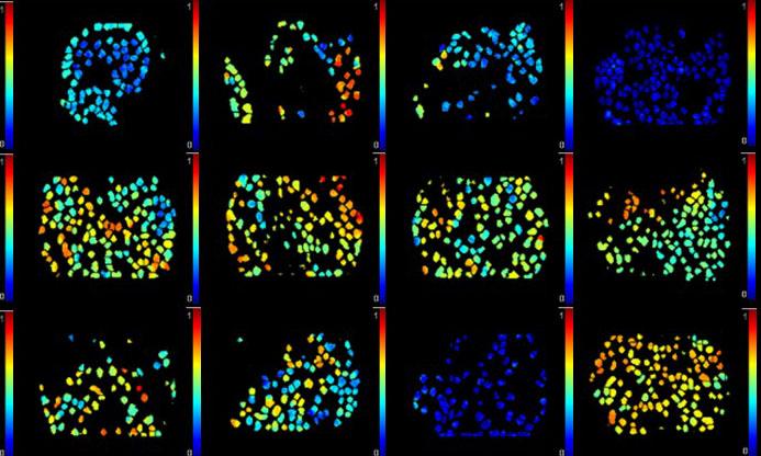 Imaging individual cancer cells in a tumor in vivo. (Source: Erik Sahai)