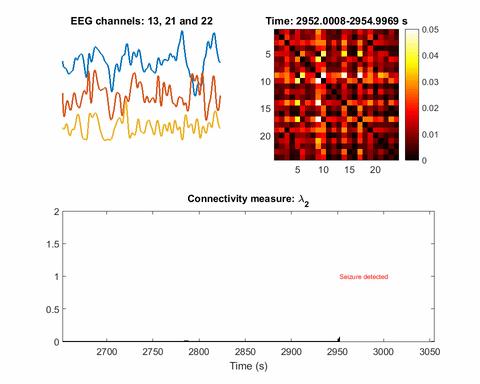 This gif was recorded during two seizures, one at 2950 seconds, the other at 9200. The top left animation is of EEG signals from three electrodes. The top right is a map of the inferred network. The third animation plots the Fiedler eigenvalue, the single value used to detect seizures using the network inference technique. Source: Li Lab