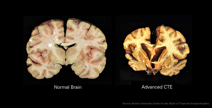 A brain without (l) and with CTE (r)