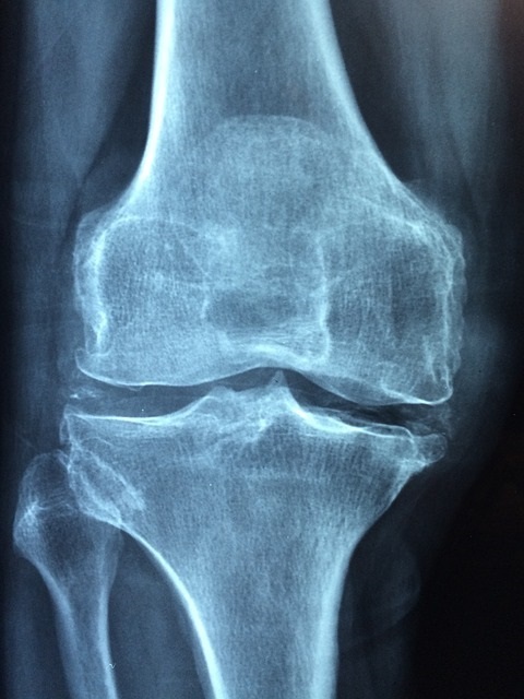 Knee replacement surgery is a common solution for people with severe, chronic knee pain.
