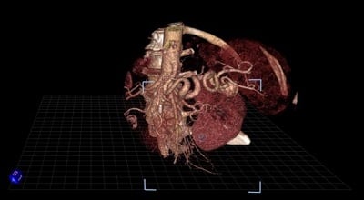 An image of a splenic artery aneurysm as it is seen in virtual reality. Source: Society of Interventional Radiology