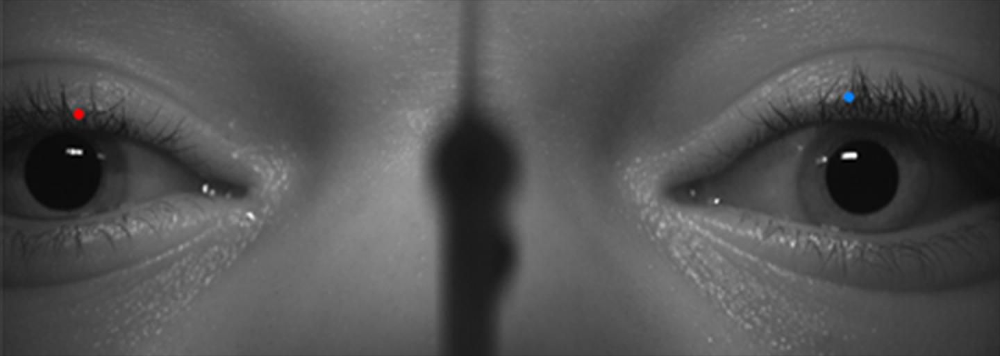 The positions of the right (red) and left (blue) eyelids during a stimulated blink are tracked over time using image processing. The technique produces rapid, non-invasive, and objective measurements of blink parameters, making it a useful tool for assessing neurological function. Source: Tsai NT, et al.