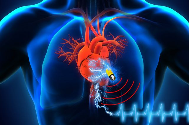 The supercapacitor invented by researchers from UCLA and the University of Connecticut could lead to pacemakers and other implantable medical devices that last a lifetime. (Islam Mosa/University of Connecticut and Maher El-Kady/UCLA)
