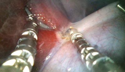 Robot arms perform an incision during an ex-vivo test on a porcine gallbladder. Source: KAIST