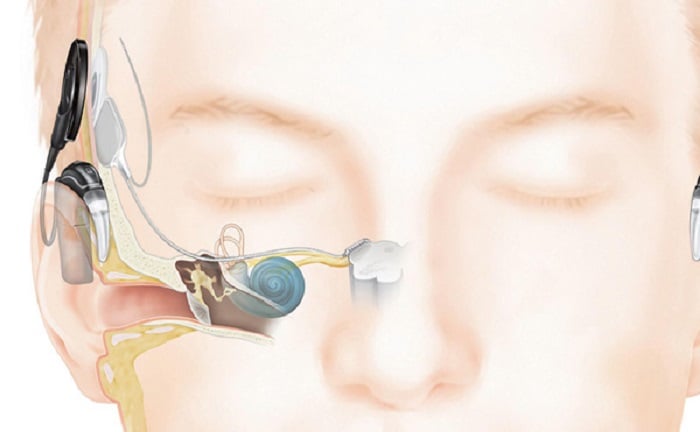 An auditory brainstem implant includes a sound processor, worn behind the ear, and an implant that connects below the skin. Source: Cochlear Americas