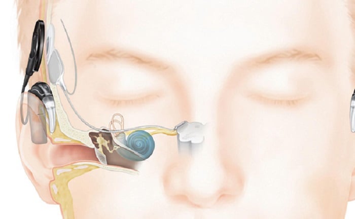 auditory nerve tumor