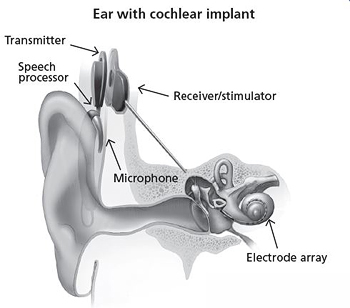Cochlear implants do not amplify existing sound like hearing aids do, but rather help neurologically process the signals and learn to interpret it as sound. Source: NIDCD