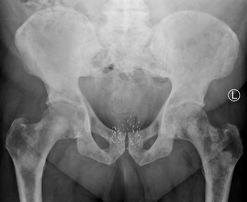 Brachytherapy seeds in the prostate. Source: radiopaedia.org